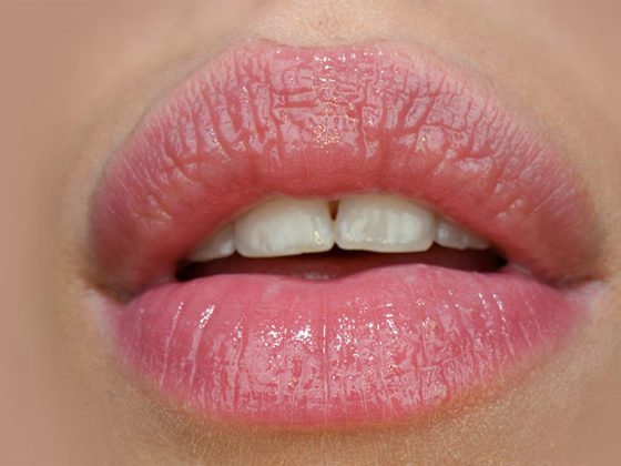 Habana Lips. Cómo bajar la hinchazón por ácido hialurónico