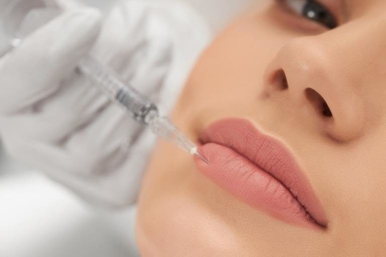 ¿Qué hacer después de una inyección de relleno de labios?. Relleno de labios con ácido hialurónico