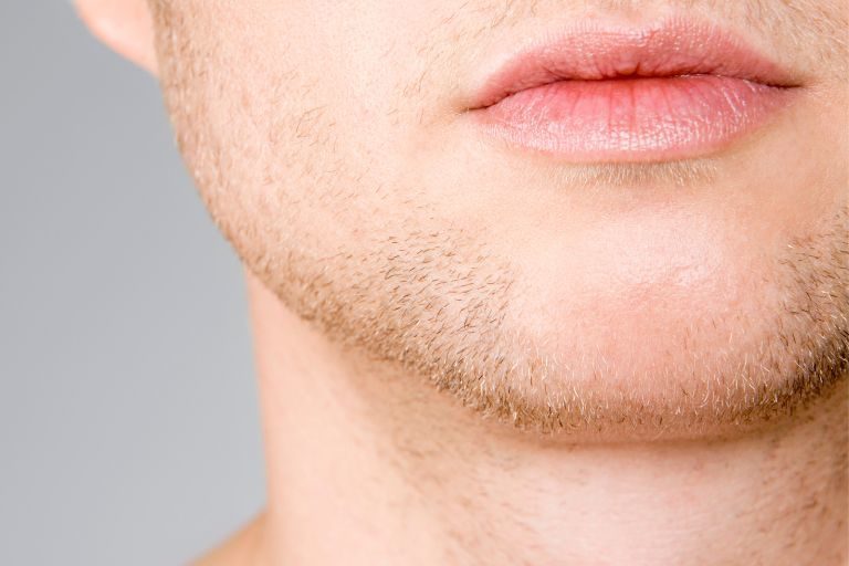 Hombre con Mentón con ácido hialurónico, Habanna lips