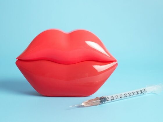 relleno de labios con ácido hiallurónico en madrid